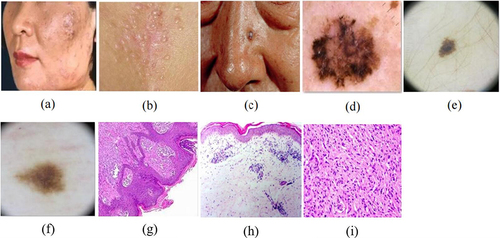 Figure 1 Comparison of clinical skin images (a–c), dermoscopic images (d–f), and tissue-biopsy pathology images (g–i). The gold standard for skin disease diagnosis is based on tissue-biopsy pathology images, but high-quality equipment and testing techniques are required. Dermoscopic images are obtained using a microscope, which can only test lesions in block or dot shape. Clinical images are influenced by the angle of photography and the intensity of light, and are almost always obtained under different lighting conditions and uneven focal lengths of the lesion, resulting in greater external interference.