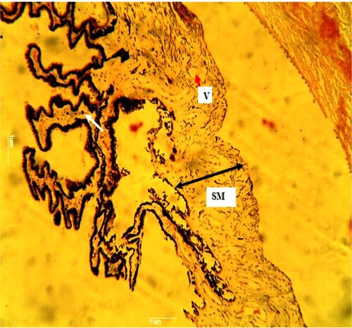 Plate 3. (Standard control): Reduced pigmentation in the simple columnar epithelium of the inner layer (white arrow). The folds are not reduced in number but reduced in size. The bundles of smooth muscle (SM) (black arrow) are arranged longitudinally. A few vacuolated (V) (red arrow) spaces within the ciliary muscle. H&E. mag. 100X.