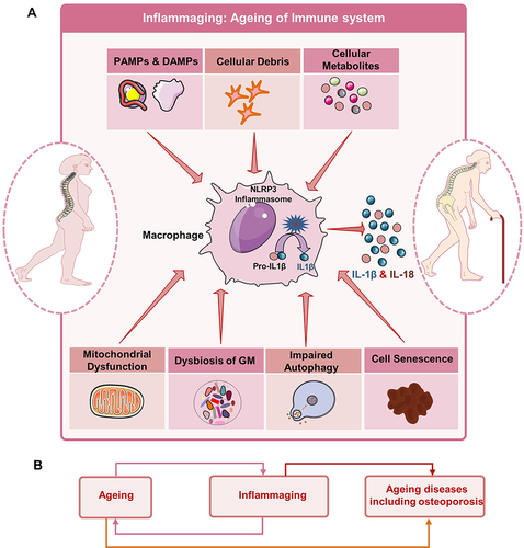 Figure 4 Inflammaging and Osteoporosis: (A) Various factors such as dysfunctioning of mitochondria, autophagy/mitophagy, dysbiosis of gut microbiota (GM), senescence of cells, cell debris, pathogen associated molecular patterns (PAMPs), death associated molecular patterns (DAMPs) and altered metabolites promote the activation of NLR family pyrin domain containing 3 inflammasome in macrophages. Activation of macrophages leads to conversion of the inactive form of IL-1β cytokine to the active form along with IL-18 cytokine. These osteoclastogenic cytokines further skew the balance towards bone resorption, thereby enhancing bone loss. (B) Dogma representing the nexus between ageing, Inflammaging, and age-related diseases including osteoporosis.