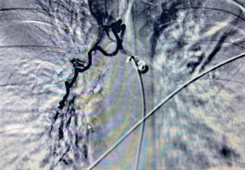 Figure 2 Contrast agent spilling from the distal end of the right pulmonary bronchial artery.