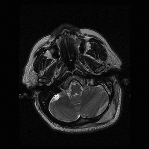 Figure 2a. MRI axial T2 image revealing high signal intensity within left suboccipital soft tissue and epidural space.