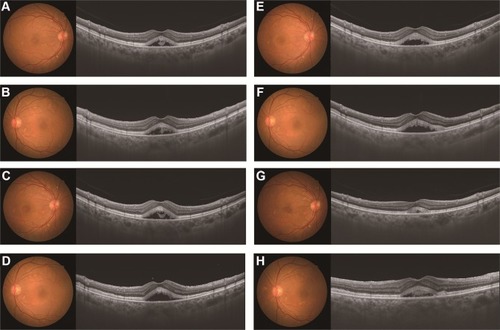 Figure 5 Time course of the fundus photographs and the SS-OCT images during the patient’s course of follow-up examinations. Fundus photographs and SS-OCT images at 1, 2, 3 and 4 months post-ipilimumab treatment. At 1 month, best corrected visual acuity was 16/20 in both eyes. SS-OCT revealed a slight increase in the height of the SRD at the central macula, compared to that found for the initial visit. The heights were 275 μm in the right (A) and 309 μm in the left (B) eye. At 2 months, the heights of the SRD in the right (C) and left (D) eyes were 323 μm and 345 μm, respectively. At 3 months, the heights were 323 μm in the right (E) and 345 μm in the left (F) eye. At 4 months, the heights were 158 μm in the right (G) and 232 μm in the left (H) eye. There were no changes noted in the patient’s visual acuity during the course of follow-up examinations, with Snellen chart best corrected visual acuity of 16/20. Although the height of the SRD was reduced at 4 months, the SRD was still slightly observed. The high reflection of the photoreceptor outer segment also remained at 4 months.