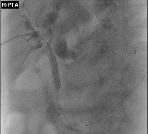 Figure 1 Percutaneous transhepatic balloon dilatation of a proximal common bile-duct stricture.