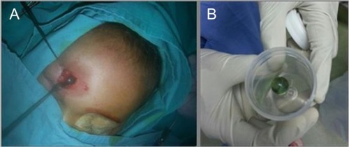 Figure 4 Wound exploration revealed a marble embedded in the left frontal bone (A) which is unshattered (B).