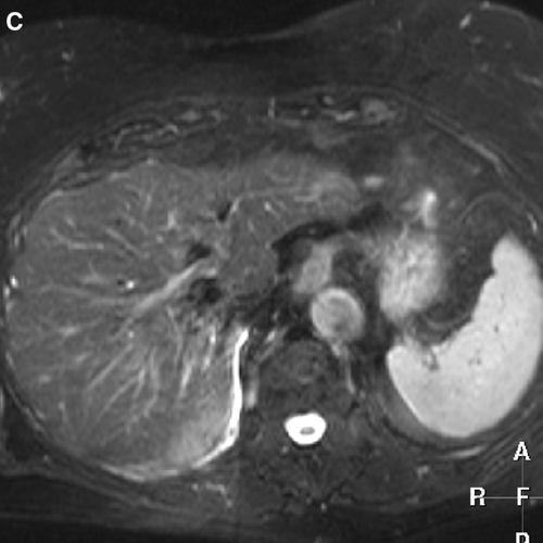 Figure 1C.  T2-weighted MR image shows complete remission with morphological parenchymal changes due to radiation hepatitis 21 months after treatment.