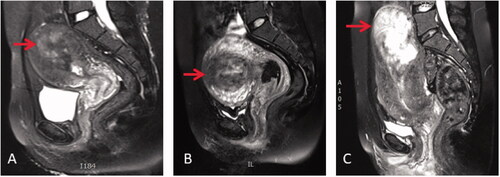 Figure 1. T2 weighted MRI of patients with different placenta accreta spectrum disorders. (A) placenta accreta: the villi simply attach to the myometrium (red arrow); (B) placenta increta: the villi invade into the myometrium (red arrow); (C) placenta percreta: the villi invade the full thickness of the myometrium (red arrow).