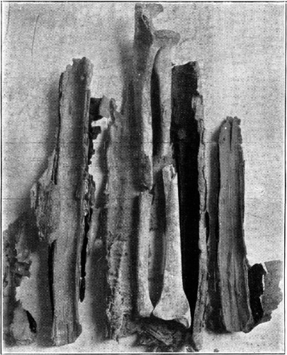 Figure 1. Compound fracture of the forearm with unwrapped bark splints. From Smith (Citation1908).