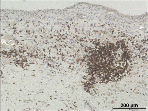 Figure 2. Immunohistochemistry with antibody to CD3 antigen was performed in order to identify T-lymphocytes within the synovial soft tissue. In this particular case, both perivascular (mid right) and diffuse CD3+ lymphocytes were detected. Polyethylene wear particles were apparent under polarized light microscopy in several foreign body giant cells and histiocytes. (Embedding in paraffin wax; microscopic analysis under polarized light; immunohistochemical reaction with CD3 antibody).