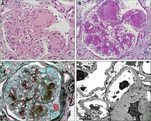 Figure 1 Characteristic histological features of diabetic nephropathy.