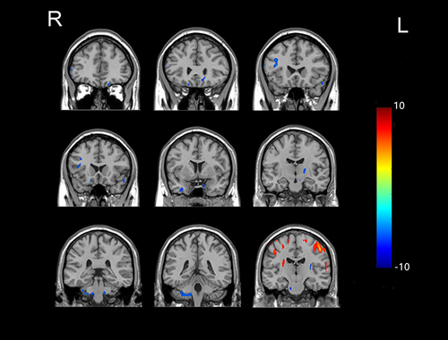 Figure 3 The cerebral regions with significantly different normalized CBF between the GTCS patients and healthy subjects in the coronal sectional image. (FWE corrected p < 0.05). The locations of the brain regions are the same as those in Figure 2.