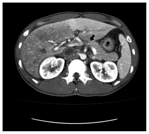 Figure 1 Abdominal CT scan showing extensive thrombus formation at presentation. Lack of opacification of the segmental portal vein after contrast injection indicates recent thrombosis.