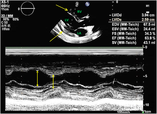 Figure 1 A 2D (top) and M-mode (bottom) imaging of parasternal long-axis echocardiogram showing pericardial tamponade. Bright yellow arrows show dark echo-free signal from pericardial fluid with left ventricular contraction in both end-diastolic and end-systolic.