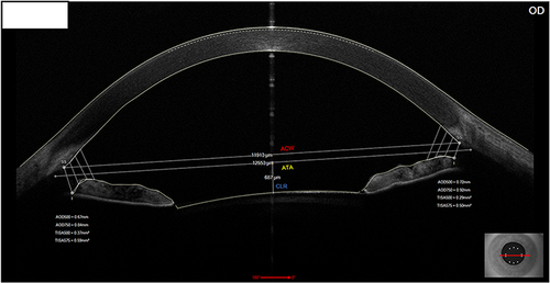 Figure 6 Angle-to-angle (ATA) diameter measurement with optical coherence tomography (OCT). The distance from the anterior surface of the crystalline lens to the ATA line is the crystalline lens rise (CLR). The anterior chamber width (ACW) from scleral spur to scleral spur is also marked. Courtesy of Arthur Cummings.