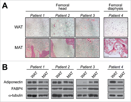 Figure 3. Adiponectin expression in human femoral MAT. Subcutaneous WAT and MAT were isolated from the femoral heads of patients undergoing hip-replacement (Patients 1–3) or from the femoral diaphysis of an amputation patient (Patient 4). (A) Representative micrographs of H&E-stained tissue sections. Scale bar = 200 µm. (B) Total protein was isolated from scWAT and MAT of each patient and expression of the indicated proteins was assessed by immunoblotting; similar results were observed for tissue samples obtained from two other hip-replacement patients (data not shown). Expression of α-tubulin was analyzed as a loading control, although expression was sometimes variable between each tissue type. For patients 1–3, MAT and scWAT lysates were run on non-adjacent lanes of the same gel, and therefore intervening lanes have been removed for ease of comparison. Both the Institutional Review Boards of the University of Michigan and of the Veterans Affairs Hospital of Ann Arbor, MI, approved the study involving hip-replacement patients (IRB number: HUM00053722). The University of Michigan Medical School Institutional Review Boards approved the study involving lower-limb amputation patients (IRB number: HUM00060733). Methods for histology and immunoblotting are as described previously.Citation4