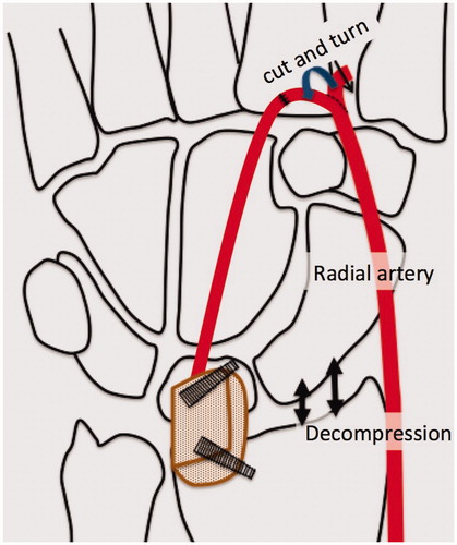 Figure 4. Diagrams of the surgical procedure. The bone graft was placed between the lunate and radius with a slight distraction of the lunate. End–to-end anastomosis was performed into the dorsal branch of the radial artery.
