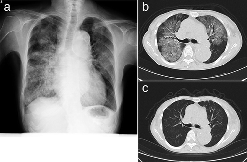 Figure 1. (a) Chest X-ray and (b) CT on admission showing diffuse infiltrative and ground glass opacities in both lungs. (c) A CT mage obtained after 52 days of steroid treatment