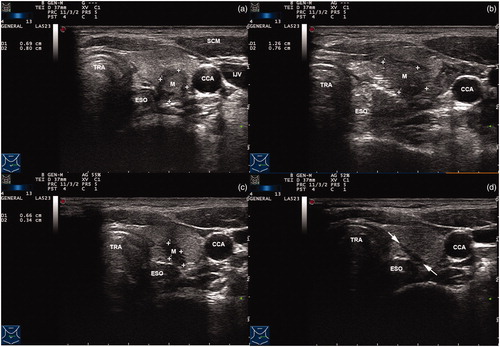 Figure 9. Ultrasound images of MWA in a patient with solitary PTC in our institution. (a) Before MWA therapy; (b) Immediately after MWA therapy; (c) 3 months after MWA therapy; (d) 18 months after MWA therapy.