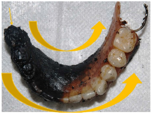 Figure 5 Lower denture where the direction of the fire was from the right to the left side (large arrows), on the lingual and vestibular surfaces.