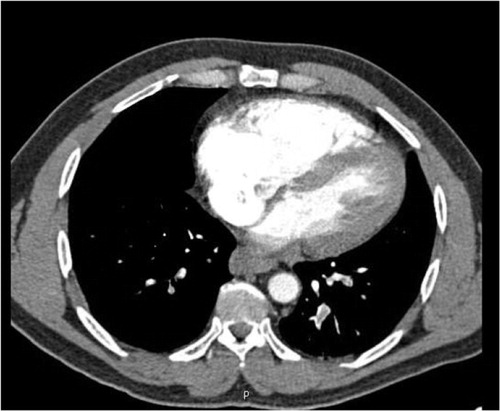 Fig. 1 CT chest angiogram shows straightening of the interventricular septum.