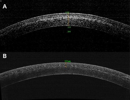 Figure 1 AS-OCT of corneal stromal demarcation line at postoperative month 1 in after pulsed-light-accelerated CXL with 30 mW/cm2 (A) and 45 mW/cm2 (B) irradiances.Abbreviation: CXL, corneal crosslinking.