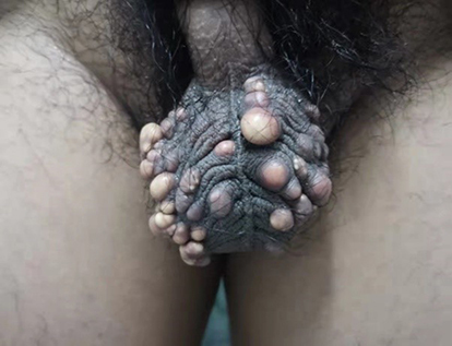 Figure 1 Scattered yellowish-white nodules in the scrotal skin, varying in size, with clear boundaries.