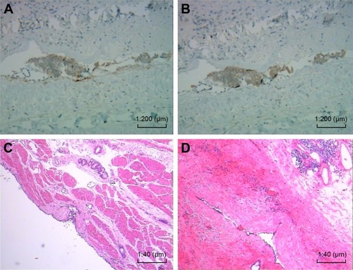 Figure 4 Immunohistochemical and histopathological examination of the cyst sections. (A) Positive expression of CA199, original magnification ×200. (B) Positive expression of CA125, original magnification ×200. (C, D) The cystic wall was lined with ciliated columnar epithelium. The wall also contained cartilage and bronchogenic glands (H&E stained, original magnification ×40).