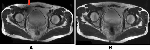 Figure 8 Effects of dielectric pads on 3T pelvic MRI artifact reduction. The solid red arrow in (A) depicts a signal dropout in the absence of a dielectric pad. (B) Signal is enhanced by the use of a dielectric pad [Courtesy Allen D Elster, MRIQuestions.com].Citation37