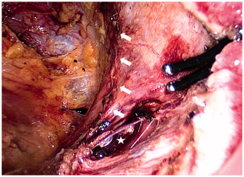 Figure 4. Electrophysiologically assessed posterior branches of the inferior rectal plexus (arrows). Former exidental opening of levators fascia (star)