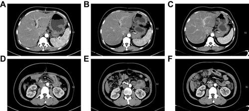 Figure 7 The result of CT-abdomen after operation. There is no sign of recurrence of metastasis. (A and D) The CT-abdomen result on September 4, 2019; (B and E) the CT-abdomen result on March 23, 2020; (C and F) the CT-abdomen result on October 10, 2020.