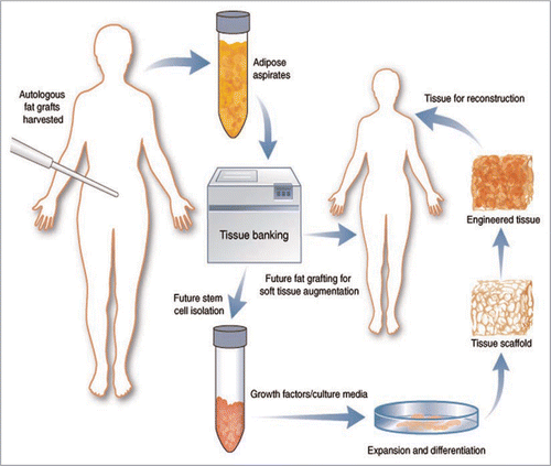 Figure 4 A schematic diagram shows possible future autologous fat transplantation or cell-based therapy for engineered tissue reconstruction after successful cryopreservation of the patient's own adipose tissue collected from conventional liposuction. (From Pu LLQ. Cryopreservation of adipose tissue for fat grafting: Problems and potential solutions. in eds. Coleman SR, Mazzola RF. Fat injection: From Filling to Regeneration. St. Louis: Quality Medical Publishing 2009; 85).