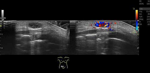 Figure 5 Doppler ultrasound of a 1-day-old newborn with a bluish subcutaneous nodule in the anterior abdominal wall shows a well-circumscribed hypoechoic lesion in the subcutaneous plane with internal hypervascularity, compatible with soft tissue hemangioma.