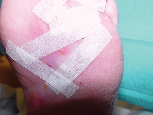 Figure 2 Apligraf ® that has been fenestrated and applied directly to the wound bed. It is held in place with steri-strips.