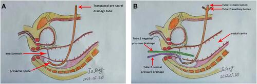 Figure 2 Tube placement pattern diagram. The indwelling trans-sacral presacral common single-lumen drainage tube (A). Tube 1 is a 22-Fr three-lumen balloon catheter, which is the placement of the fistula lumen from the suprapubic bone, tube 2 is inserted transanally into the fistula lumen, tube 3 is inserted into the rectum through the anus (B).