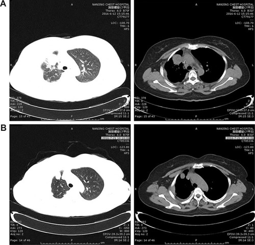 Figure 2 Patient II: Computed tomography shows the mass in the right lung (A) before apatinib treatment and (B) after apatinib treatment was given for 1 month.