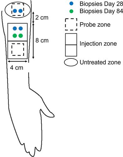 Figure 1 Schematic of treatment, assessment, and biopsy zones.