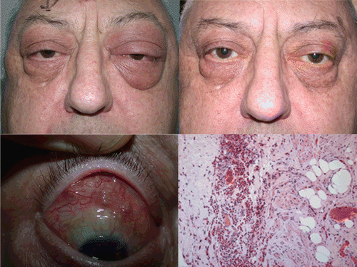 FIGURE 1  Patient with CSS, with bilateral asymmetric periocular edema and proptosis (top left). Subconjunctival nodules on the superior bulbar conjunctival surface (bottom left). Reduced periorbital soft tissue swelling and proptosis following treatment with systemic corticosteroids (top right). Histology of biopsied conjunctival nodules shows the presence of a prominent number of eosinophils with necrotising eosinophilic granulomata, in keeping with CSS (bottom right).