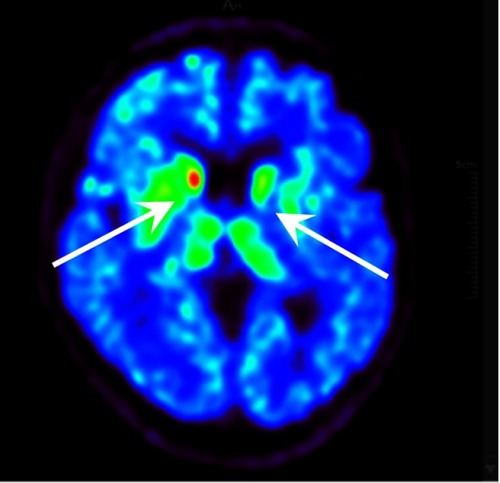 Figure 3 PET-CT image of VMAT2 distribution in a Hoehn–Yahr stage 3 patient with freezing of gait. Two white arrows indicate severe dopamine decline of bilateral putamens in cases.