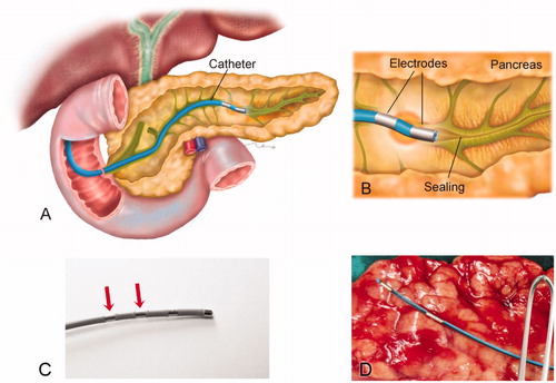 Figure 1. (A) Overview of the catheter-based technique for endoluminal radiofrequency sealing of pancreatic duct. The catheter is introduced into the pancreatic duct through the papilla. (B) Detail of catheter tip in which RF power is applied between two electrodes. The thermal lesion causes the duct to seal (the illustration is that of a human pancreas). (C) 5 Fr bipolar RF catheter used for ex vivo ablations on bovine liver (the most proximal electrodes were used for ablations). (D) 3 Fr bipolar RF catheter used for ex vivo and in vivo ablations on porcine pancreas.
