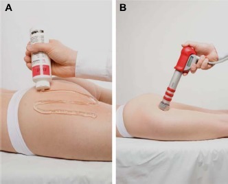 Figure 2 Radial shock wave therapy for cellulite.
