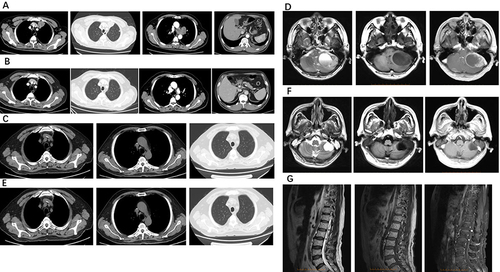 Figure 3 Baseline before immunotherapy. (A) 4 cycles after immunotherapy. (B) February 2021, chest CT before cystic brain metastasis. (C) March 2021, cystic brain metastasis. (D) April 2021, chest CT SD. (E) September 2021; 6 months after cystic brain metastases occurred. (F) March 2022, spinal metastasis. (G).
