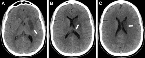 Figure 5 Control cerebral CT-scan performed 24 hours after reperfusion therapies showing a left lenticulostriate (A, B) and caudate (C) infarct (white arrows).