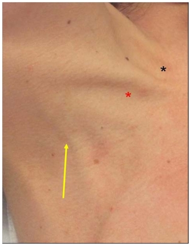 Figure 6 External jugular vein crossing the posterior border of sternocleidomastoid (arrow), Sedillot’s triangle (red star), and sternal notch (black star).