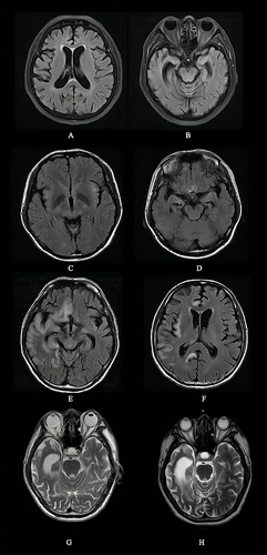 Figure 1 MRI findings of general paresis in T2 and FLAIR. (A, B) A 61-year-old female patient shows diffuse brain atrophy, dilation of lateral ventricles and widening of the sulcus. (C, D) A 31-year-old male patient shows symmetrical patchy hyperintensities in frontal lobes and corpus callosum splenium, with mild atrophy in the hippocampus. (E-H) A 61-year-old male patient shows (E, F) diffuse hyperintensities and swelling in the right temporal lobe, parietal lobe and occipital lobe and the right thalamus in 2014. In 2015 post treatment, her previous swollen and lesioned areas in 2014 were significantly atrophied, the right lateral ventricle is dilated, and the abnormal hyperintensities reduced in size as shown in (G). The right ventricle was further dilated in 2018 (H).