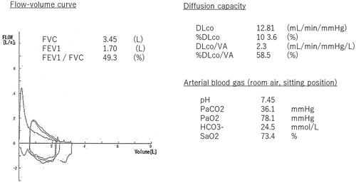 Figure 1. Pulmonary function test and arterial blood gas; FVC was 3.45 L and FEV1 and FEV1/FVC (1.7 L and 48.3%, respectively), was reduced. The %DLCO was kept at 103.0%, but %DLCO/VA was reduced (58.5%).