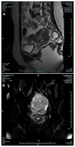 Figure 2 Magnetic resonance imaging images of dermoid cyst (A) and fibrosarcoma (B).