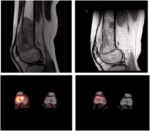 Figure 1. MRI and PET scan showing the tumor before treatment (left) and after two courses of chemotherapy (right).