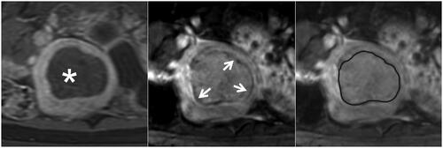 Figure 3. The complete hypointense peripheral rim on SWI. The left, Middle, and right figures are the CE, SWI imaging, and SWI sketch of the same leiomyoma. (Left) The axial CE imaging shows the range of ablated necrotic lesions, which appear as a non-enhancing hypointense zone (star). (Middle) The corresponding axial SWI shows a complete hypointense peripheral rim (arrow). (Right) The sketch map illustrates the range of the hypointense peripheral rim (black line); it involves ≥90% of the circumference of the ablated zone.