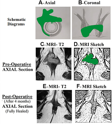 Figure 3 A 29-year-old female patient with acute anterior horseshoe abscess.