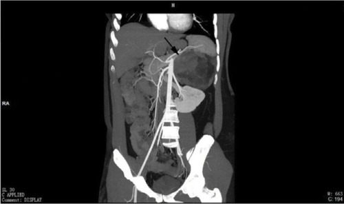 Figure 1 Abbreviation: CT, computerized tomography.