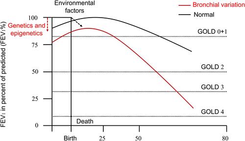 Figure 1 Rate of decline in FEV1 with genetic and environmental factors. This downtrend of FEV1 over a lifetime is determined by genetics and epigenetics before birth. Then the different curves decline in different rates dependent on organ development/repair (aging) and environmental factors (smoking and air pollutions) after birth. The lung function of people with bronchial variations is worse than that of normal people at birth. The risk of COPD is higher and earlier if environmental exposure is not taken into account.